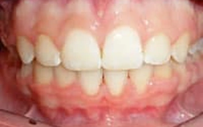 After Braces Treatment – Straighter Smile