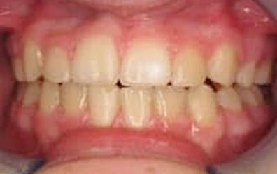 After Orthodontic Treatment – Crowding Corrected