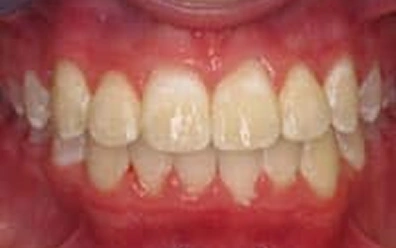 After Orthodontic Treatment – Improved Tooth Alignment