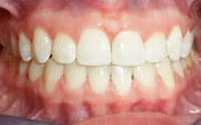 After Orthodontic Treatment – Smile Improvement