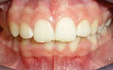 Before Braces Treatment – Front Teeth Alignment