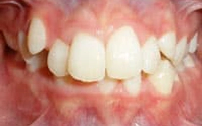 Before Orthodontic Treatment – Crowded Front Teeth