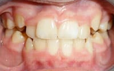 Before Orthodontic Treatment – Crowding Correction Case