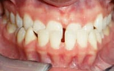 Before Orthodontic Treatment – Uneven Tooth Alignment