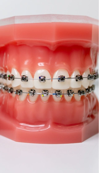Braces