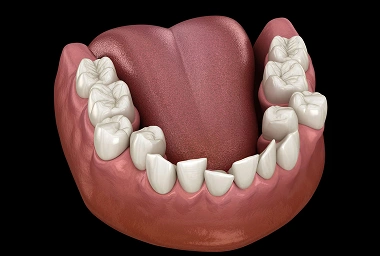 clear aligners Crowded teeth