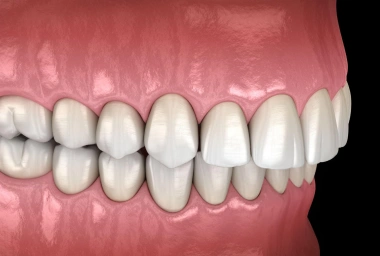 clear aligners Deep bite