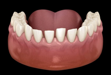 clear aligners Gaps between teeth