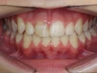 Dental implants after image