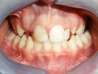 Dental implants before image