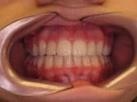 dentures after image
