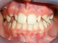 dentures before image