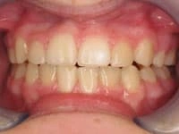 smil gallery after image