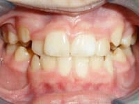 Smile hgallery before image