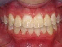smile gallery invisalign after image