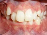smile gallery invisalign before