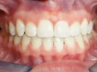 smile gallery overbite after image