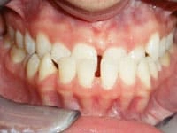 smile gallery overbite before