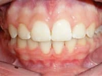 smile gallery veneers after image
