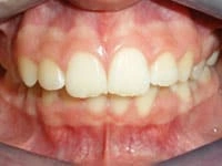 smile gallery veneers before