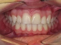 veneers after