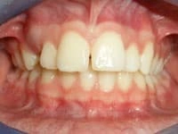 veneers before image