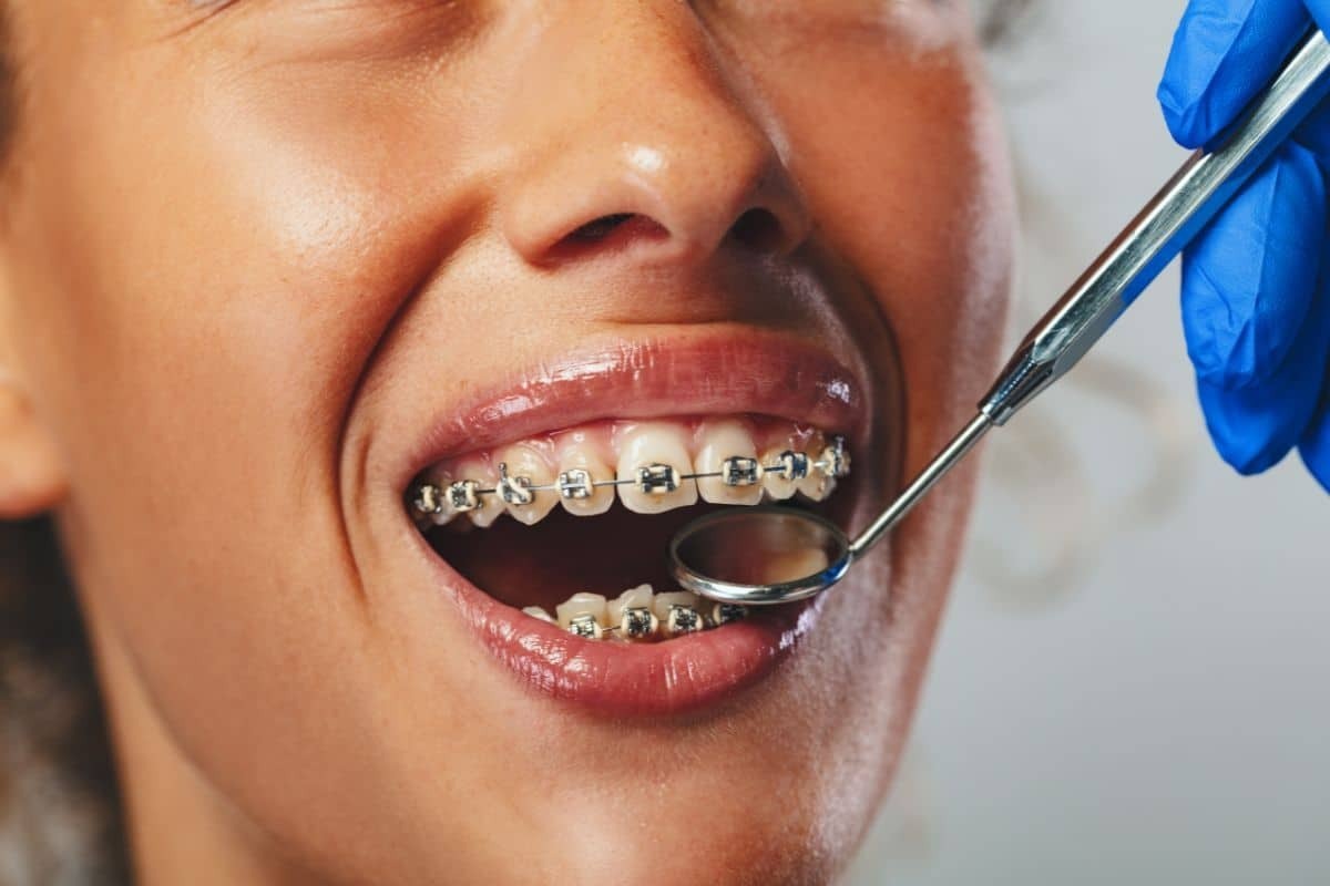 Patient with metal braces receiving orthodontic examination with dental mirror during consultation.