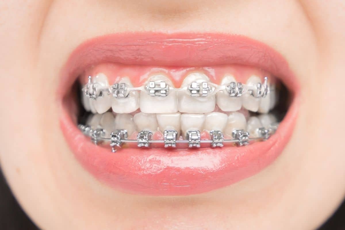 Close-up of adult patient's smile with metal braces on upper and lower teeth.